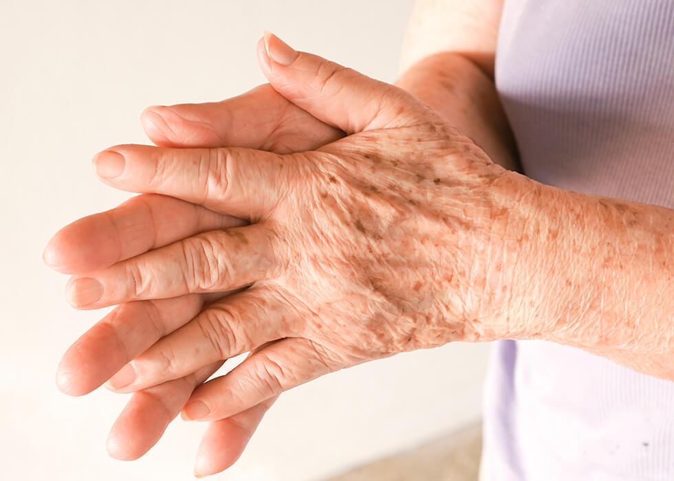 elderly hands covered in age spots.